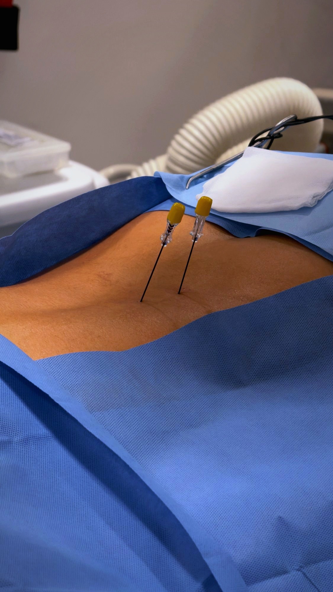 Agujas de radiofrecuencia posicionadas sobre zona de tratamiento